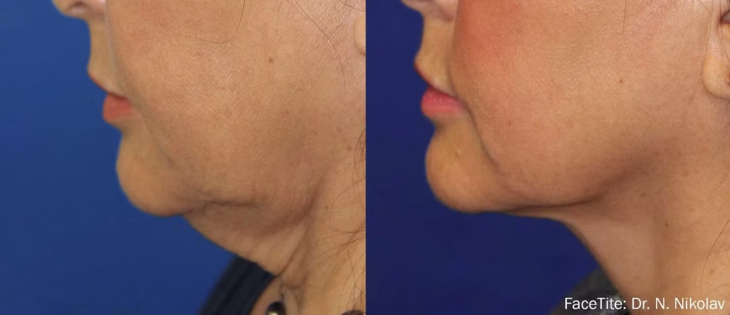 How to Get Rid of Jowls with FaceTite