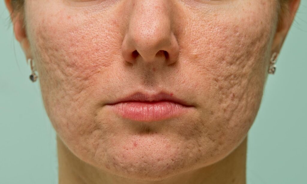Enlarged Pores Causes