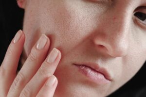 Enlarged Pores Treatment