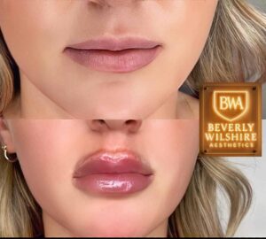 High-Volume Lip Augmentation Before and After in Beverly Hills by MD Injector.