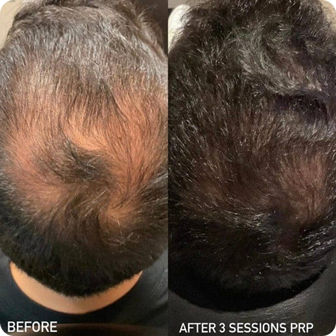 Microneedling Before & After 1