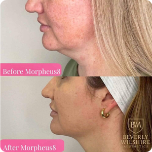 morpheus8 jowl tightening and neck definition