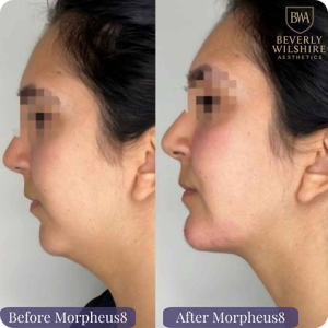 Morpheus8 Before & After 2 Treatments
