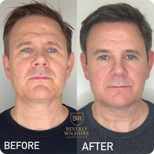 Male Morpheus8 Full Face Rejuvenation Before and After (4 Sessions)