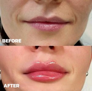Subtle Lip Filler Before and After for natural volume restoration in Beverly Hills.