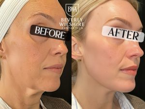 Morpheus8 RF Microneedling Dramatic Before and After Results at Beverly Wilshire Aesthetics in Beverly Hills