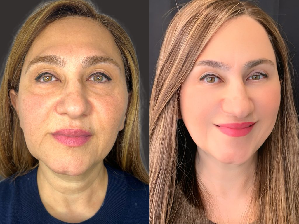 Before and After showcasing Physician Prescribed Facial Filler and Injectables for the dramatic Supreme Skin™ reveal.