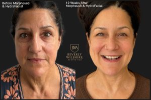 Before and after results showing facial skin texture and tone improvement 12 weeks after Morpheus8 radiofrequency microneedling combined with HydraFacial treatment at Beverly Wilshire Aesthetics in Beverly Hills.