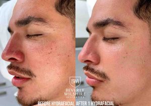 Side by Side HydraFacial Treatment Results showing a clear reduction in acne and visible glowing skin on male client at Beverly Wilshire Aesthetics in Beverly Hills