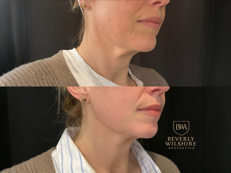 Morpheus8 Skin Tightening Before and After 3 Treatments Results