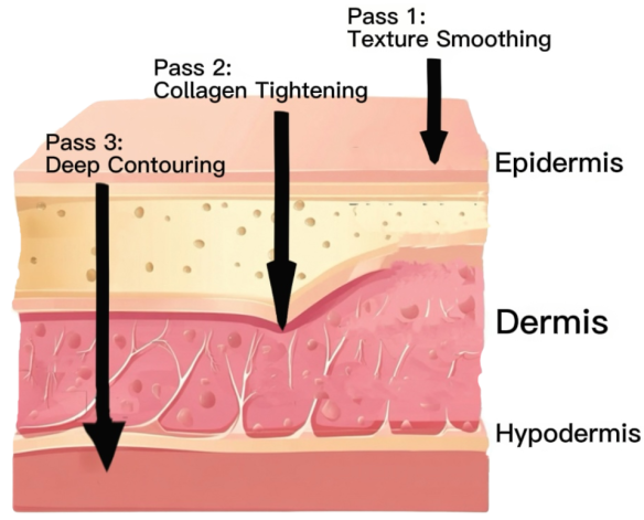 Triple-Pass Morpheus8 protocol diagram showing needle depth targeting the Epidermis for Texture, Dermis for Collagen, and Hypodermis for Deep Contouring.