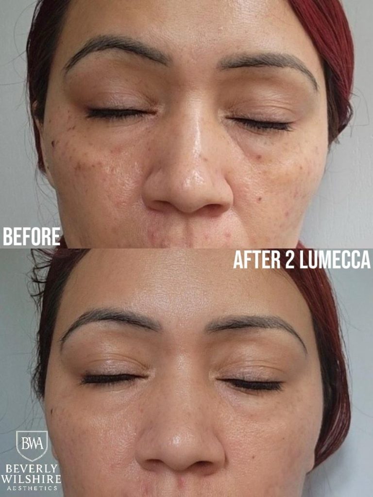 Lumecca IPL Beverly Hills Client Before and After e1771830733309