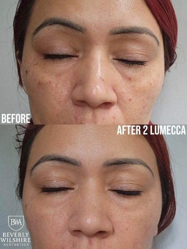 Lumecca IPL before and after results for facial pigmentation and sun spot removal after two treatments.