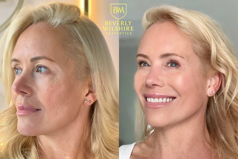 Lumecca IPL Beverly Hills Full Face Photorejuvenation