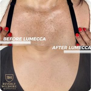 Before and after Lumecca for sun damage shows correction of dark spots and hyperpigmentation on the chest.