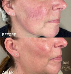 Before and after Lumecca IPL treatment shows significant reduction in severe facial redness and rosacea.