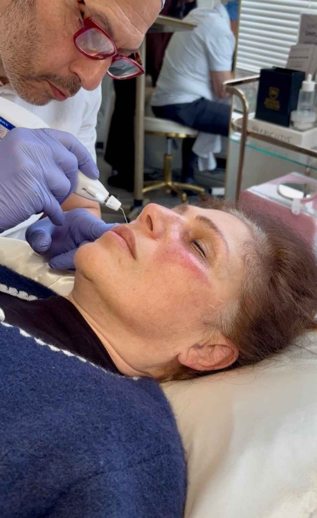 Dr Zarrini performs upper eyelid lift Beverly Hills treatment on a client at Beverly Wilshire Aesthetics.