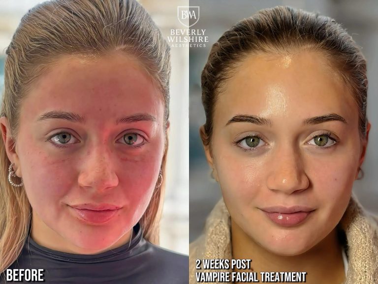 Vampire Facial Results Beverly Hills